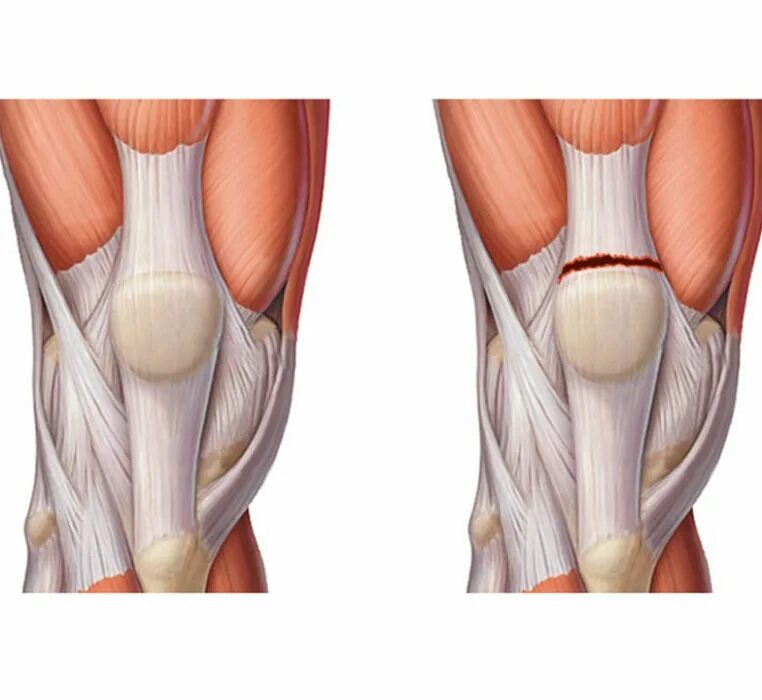 Травма связок сустава. Разрыв сухожилия четырехглавой мышцы бедра. Растяжение сухожилия четырехглавой мышцы колена. Тендинит сухожилия четырехглавой мышцы. Четырехглавая мышца коленного сустава.