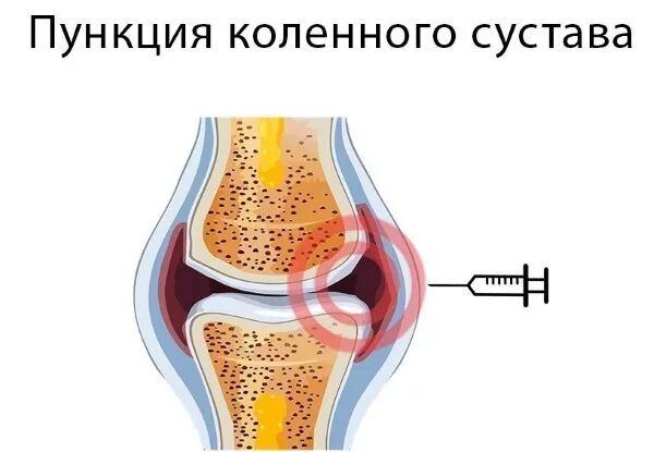 Боль в колене при сгибании хрустит. Хруст в коленях при приседании. боль в колене при приседании. болят колени при приседании и вставании причины. хруст в колене при разгибании.