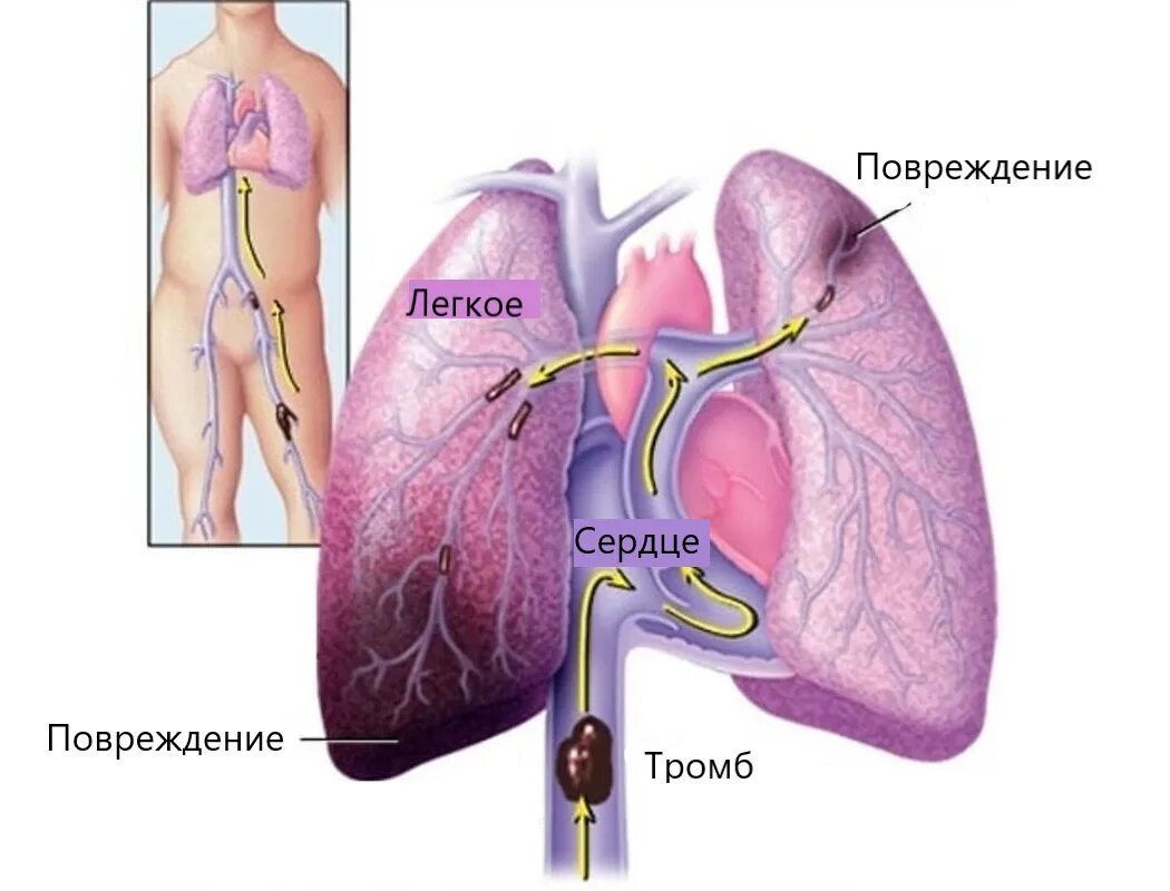 Тромбоэмболия легочной артерии. Тромб легочной артерии тромбоэмболия. Тромбоэмболия лёгочной артерии сердце. Тромбоэмболия легочной артерии симптомы. Тромботические осложнения