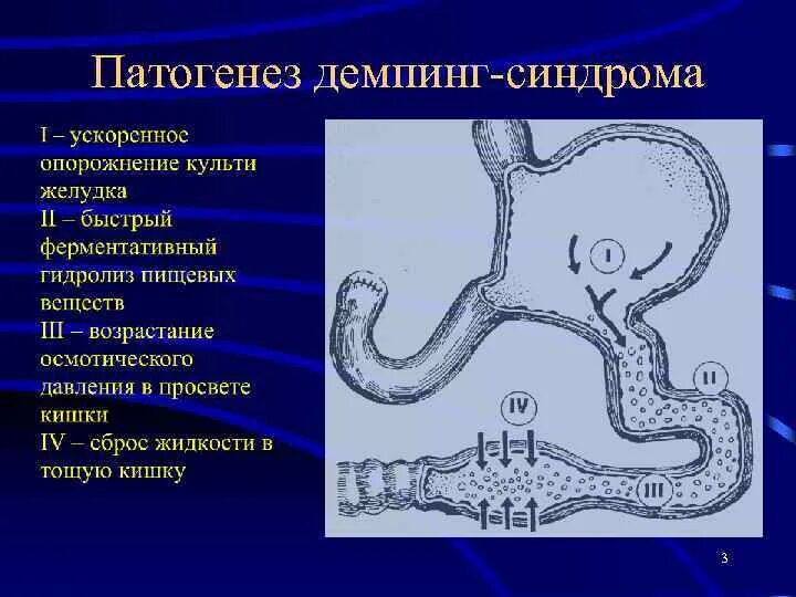 Демпинг синдром механизм развития. Демпинг синдром после резекции желудка. Синдром приводящей петли патогенез. Патофизиология оперированного желудка. Демпинг – синдром.