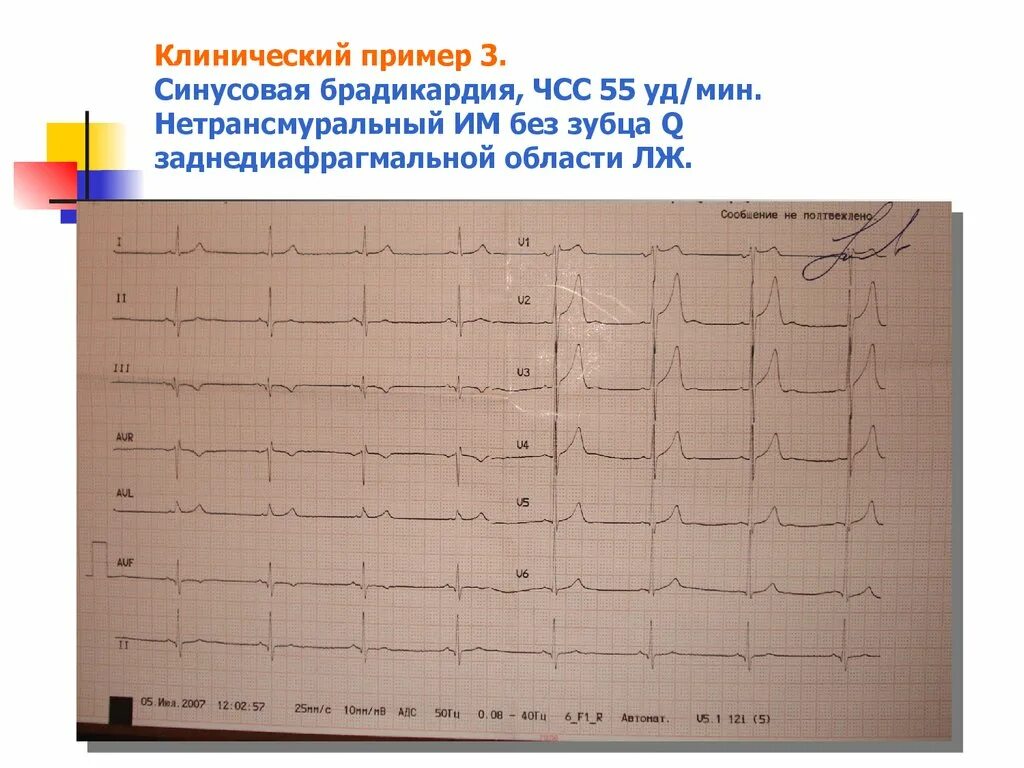 Болезни на экг. Нетрансмуральный инфаркт ЭКГ. Синусовая брадикардия пропедевтика внутренних болезней. Синусовая брадикардия с ЧСС 55 В мин. Синусовая брадикардия 40 уд/мин ЭКГ.