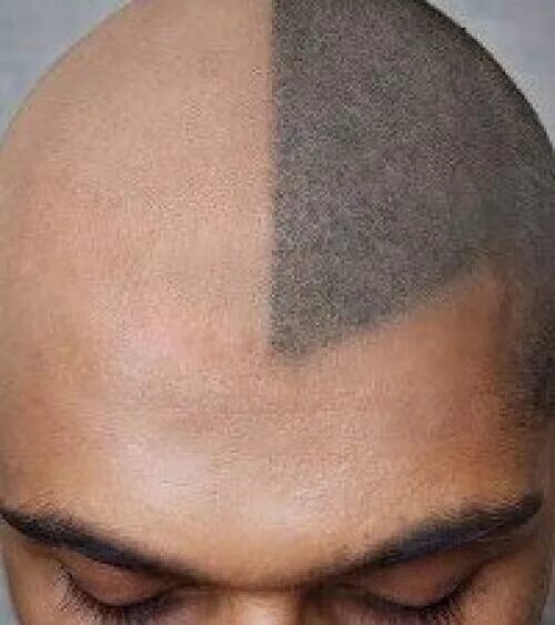 Татуаж волос на голове у мужчин. Андрей афанасьев трихопигментация. Татуаж головы имитация волос. Трихопигментация бороды. Имитация волос на голове.