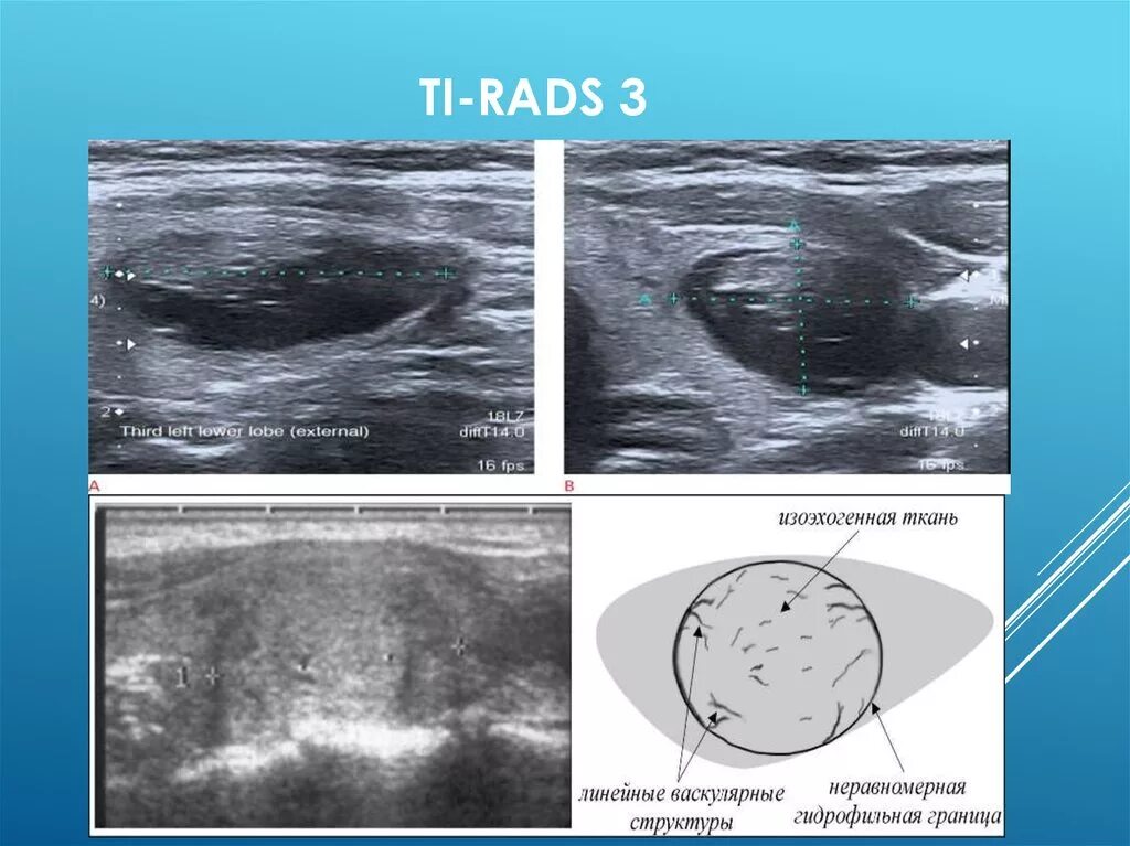 Tirads классификация узлов щитовидной железы УЗИ. Щитовидная железа УЗИ ti-rads. РАДС классификация щитовидной железы на УЗИ. Тирадс 3 щитовидной железы на УЗИ. Ti rads 3 в щитовидной