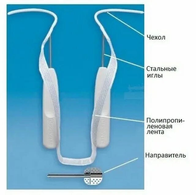 Пенальный зажим от недержания мочи у мужчин. Операция TVT-O при недержании. Слинговая операция TVT-O. Слинговая операция TVT при недержании мочи.