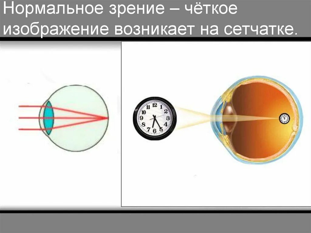 Какое изображение появляется на сетчатке глаза. Изображение на сетчатке. Нормальное зрение рисунок. На сетчатке возникает изображение. Характеристика изображения на сетчатке глаза.