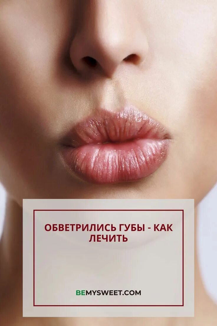 Красные губы как лечить. Обветрились губы чем лечить. как понять что губы обветрились.