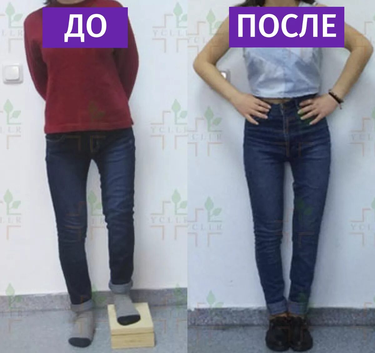 Удлинение ног до и после. Увеличение роста до и после.