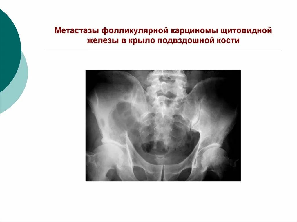 Метастазы щитовидной железы в кости. Метастазы щитовидной железы. Метастазы опухоли щитовидной железы. Метастазирование щитовидной железы.