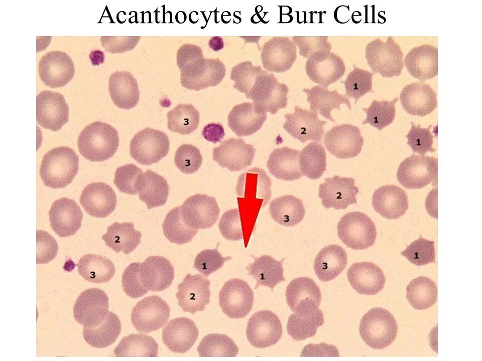 Эхиноциты. Акантоциты в мазке крови. Пойкилоцитоз эхиноциты. Эхиноциты и акантоциты. Пойкилоцитоз эритроцитов.