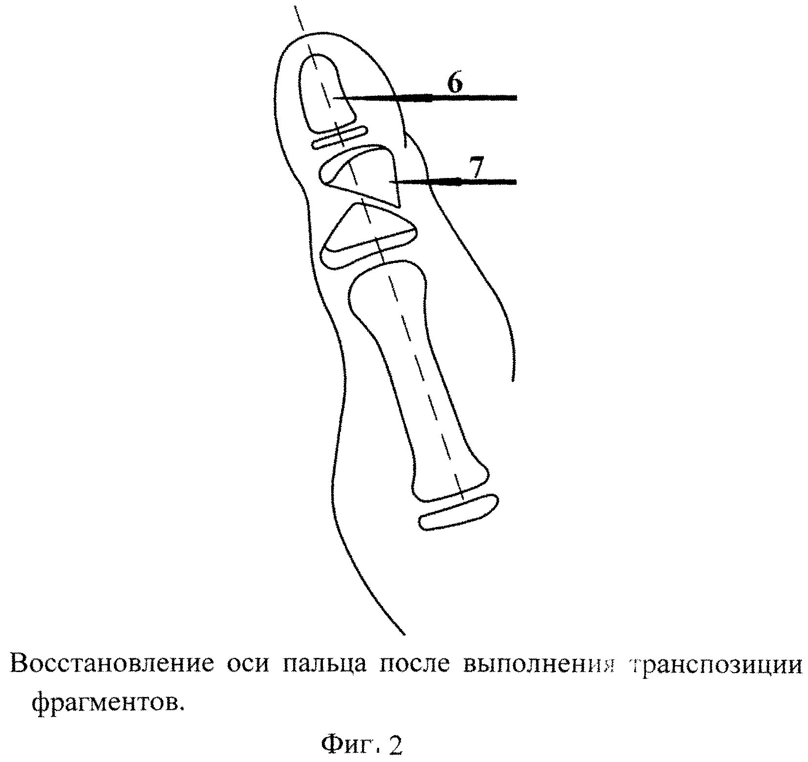 Пальцев 1 том. Клинодактилия 5 пальца рентген. Диафизы фаланг пальцев кисти. Фаланги 1 пальца кисти. Остеотомия фаланги пальца кисти.