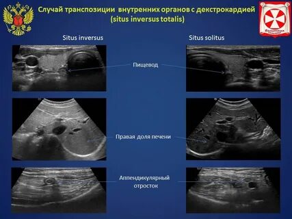 Транспозиция внутренних органов