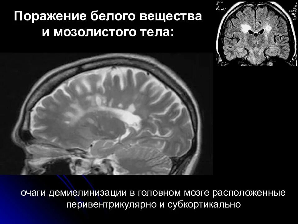 Поражение мозолистого тела при рассеянном склерозе мрт. Очаги демиелинизации на кт. Рассеянный склероз очаги в головном мозге. Очаг демиелинизации в головном на т1.