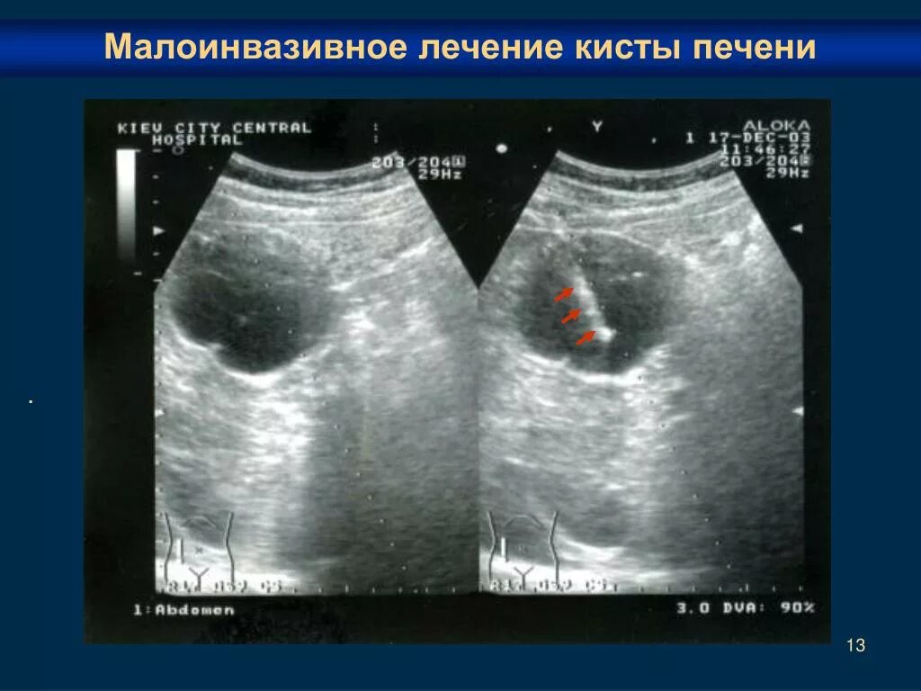 Киста на печени можно. УЗИ брюшной полости кисты печени. Ретенционные кисты печени это. Киста печени двухкамерная.