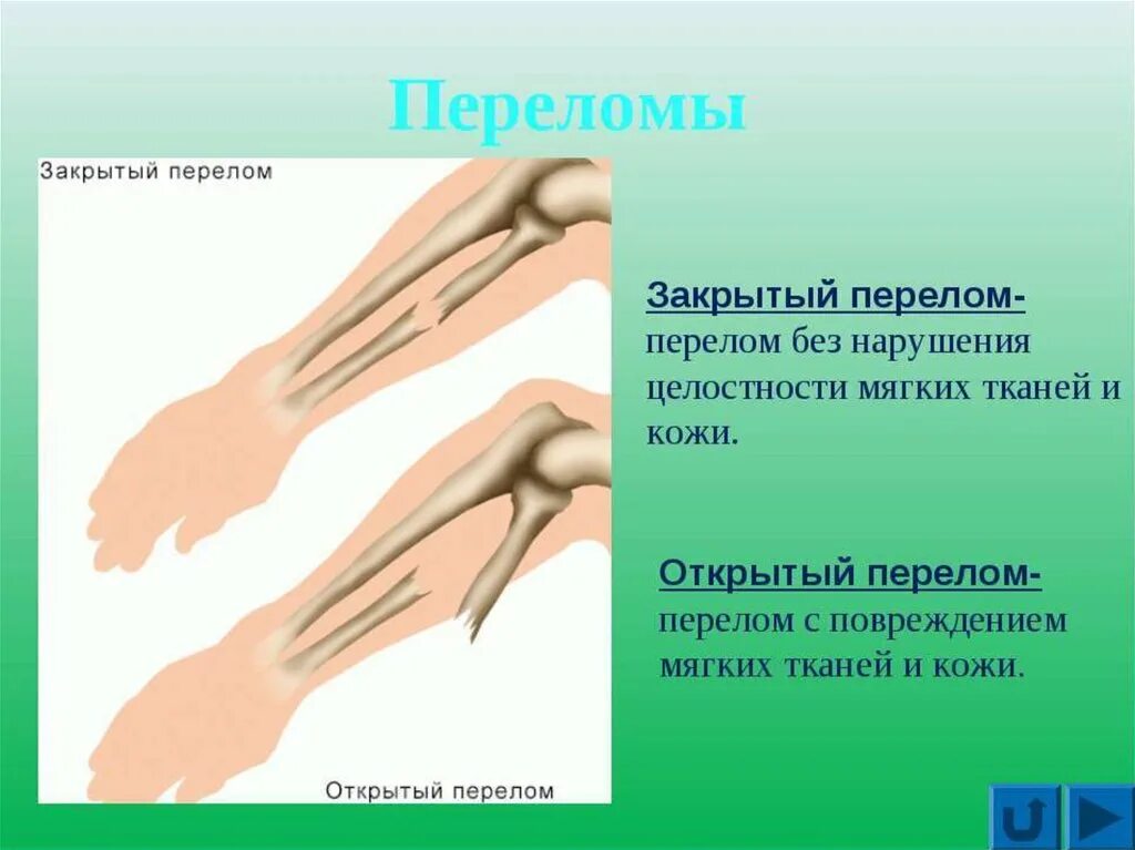 Закрытые и открытые повреждения. Открытый и закрытый перелом. Характеристика открытого и закрытого перелома. Открытые и закрытые повреждения.