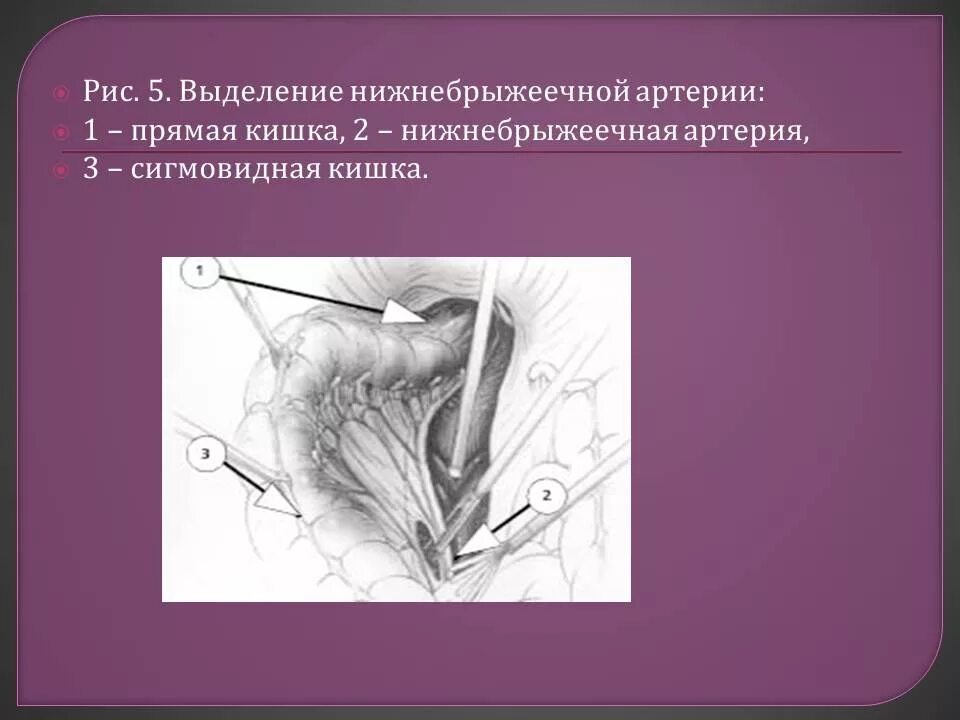 Операция Гартмана прямой кишки схема. Резекция прямой кишки по Гартману. Резекция толстой кишки по Гартману. Операция Гартмана на прямой кишке. Операции через прямую кишку