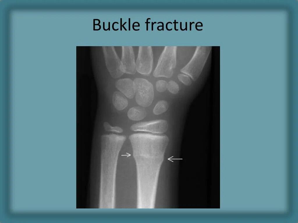 The fracture can be. The fracture can be