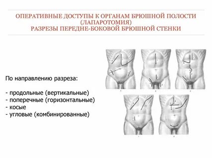 Лапаротомия код