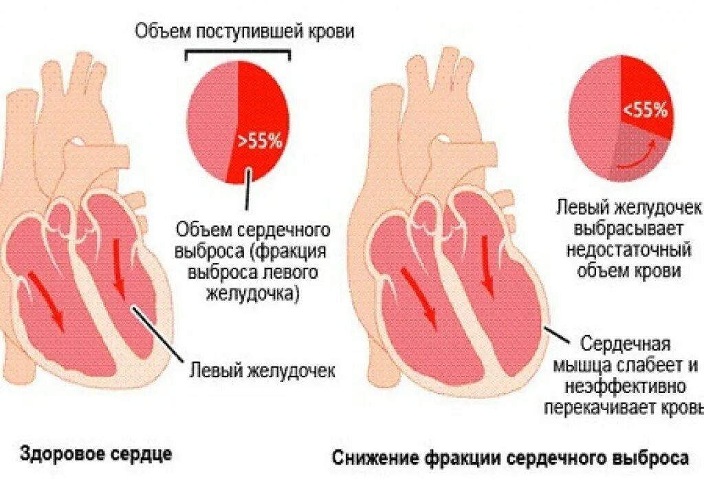Повышенный сердечный выброс. Выброс крови сердцем норма. Снижение сердечного выброса. Фракция выброса сердца. Снижение фракции выброса левого желудочка причины.
