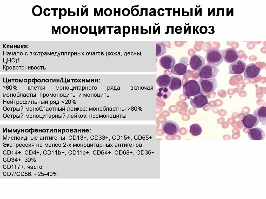 Хронический моноцитарный лейкоз показатели крови. Острый мегакариобластный лейкоз картина крови-. Острый моноцитарный лейкоз анализ крови. Лимфолейкоз показатели