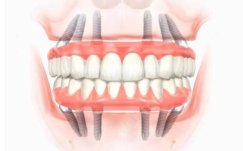 Имплантация челюсти на 6 имплантах. Имплантация зубов all on 4. All on 4 (имплантация Osstem + временное протезирование). Имплантация зубов по технологии «all on 4». Имплантация зубов all on 6