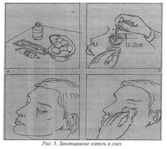 Закапывание в глаза алгоритм. Алгоритм закапывания капель. Закапывание капель в глаза пациенту. Закапывание глазных капель алгоритм. Туалет носа как делать