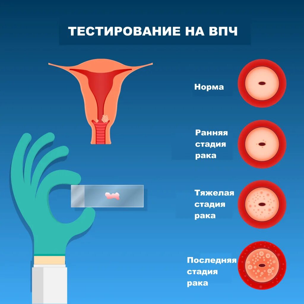 Как распознать рак матки. Как распознать рак матки