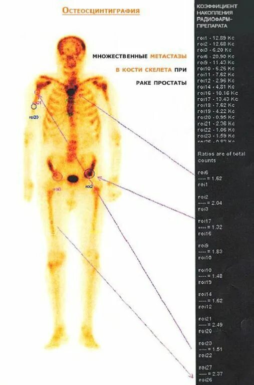 Метастазы в кости при раке предстательной. Метастазы костей скелета. Остеосцинтиграфия костей метастазы. Сцинтиграфия костей скелета (остеосцинтиграфия). Костные метастазы при сцинтиграфии.