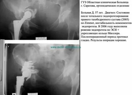Мкб 10 состояние после эндопротезирования тазобедренного сустава
