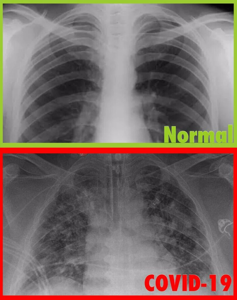 Covid 19 легкие форме. Короновирусная инфекция осложнения. Codid 19 lungs pattern ct. Covid 19 легкие форме. Матовое стекло легкие.