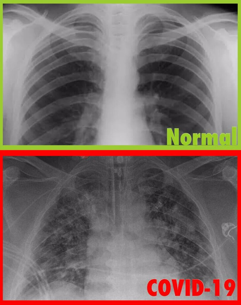 Рентген легких при Ковиде. Covid 19 рентген снимок легких.