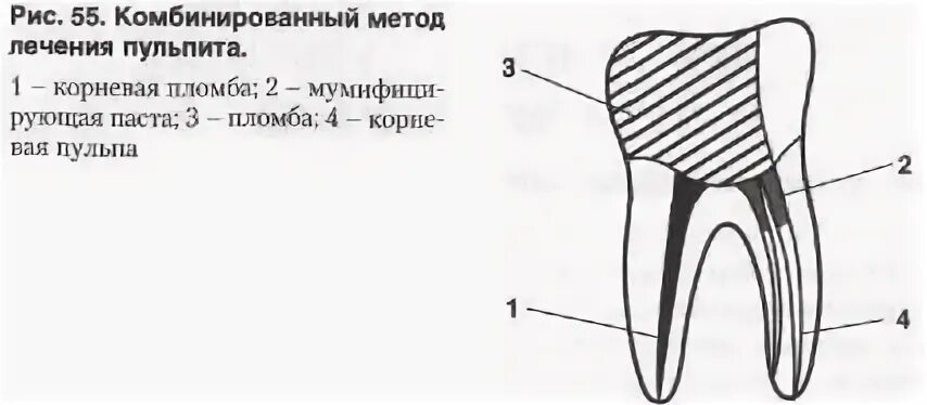 Определитель состояния пульпы