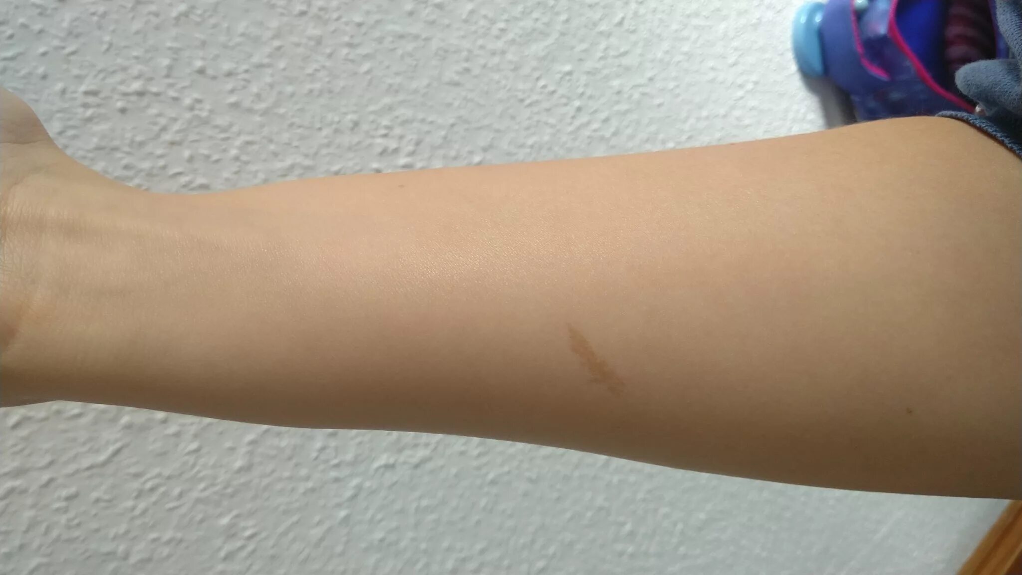 След от резинки носок на ноге. Почему на ногах остаются следы. Почему на ногах остаются следы. Почему на ногах остаются следы. Почему на ногах остаются следы.