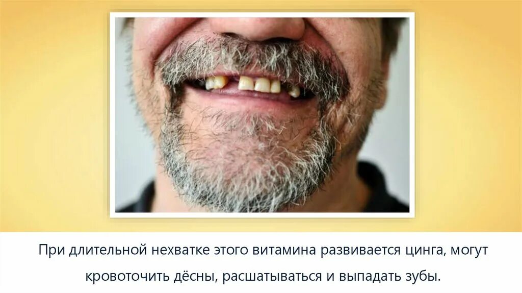 Зубы нехватки витаминов. Зубы нехватки витаминов