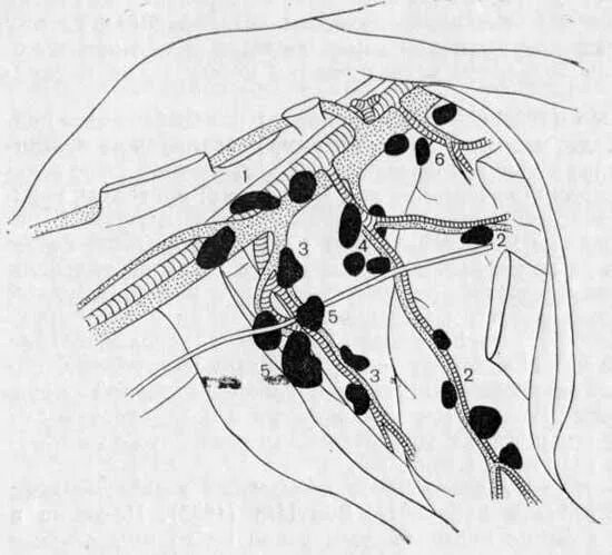 Лимфоузлы под мышками расположение у женщин. Лимфоузлы подмышечной области анатомия. Аксиллярные лимфатические узлы. Лимфоузлы подмышечные узлы. Подмышечные лимфоузлы расположение.