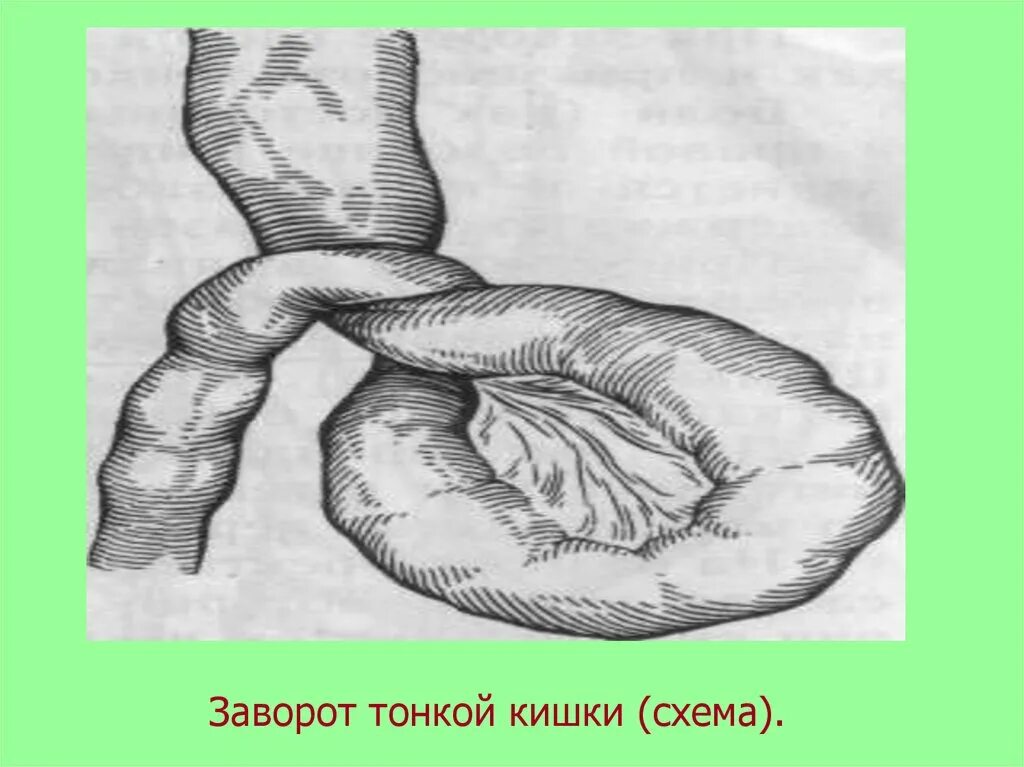 Острая кишечная непроходимость заворот. Заворот кишок непроходимость кишечника. Кишечная непроходимость заворот. Симптомы операция кишечнике