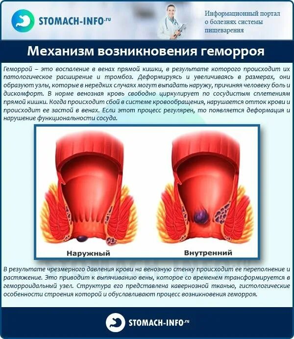 Ощущение в прямой кишке. Геморрой наружный наружный.