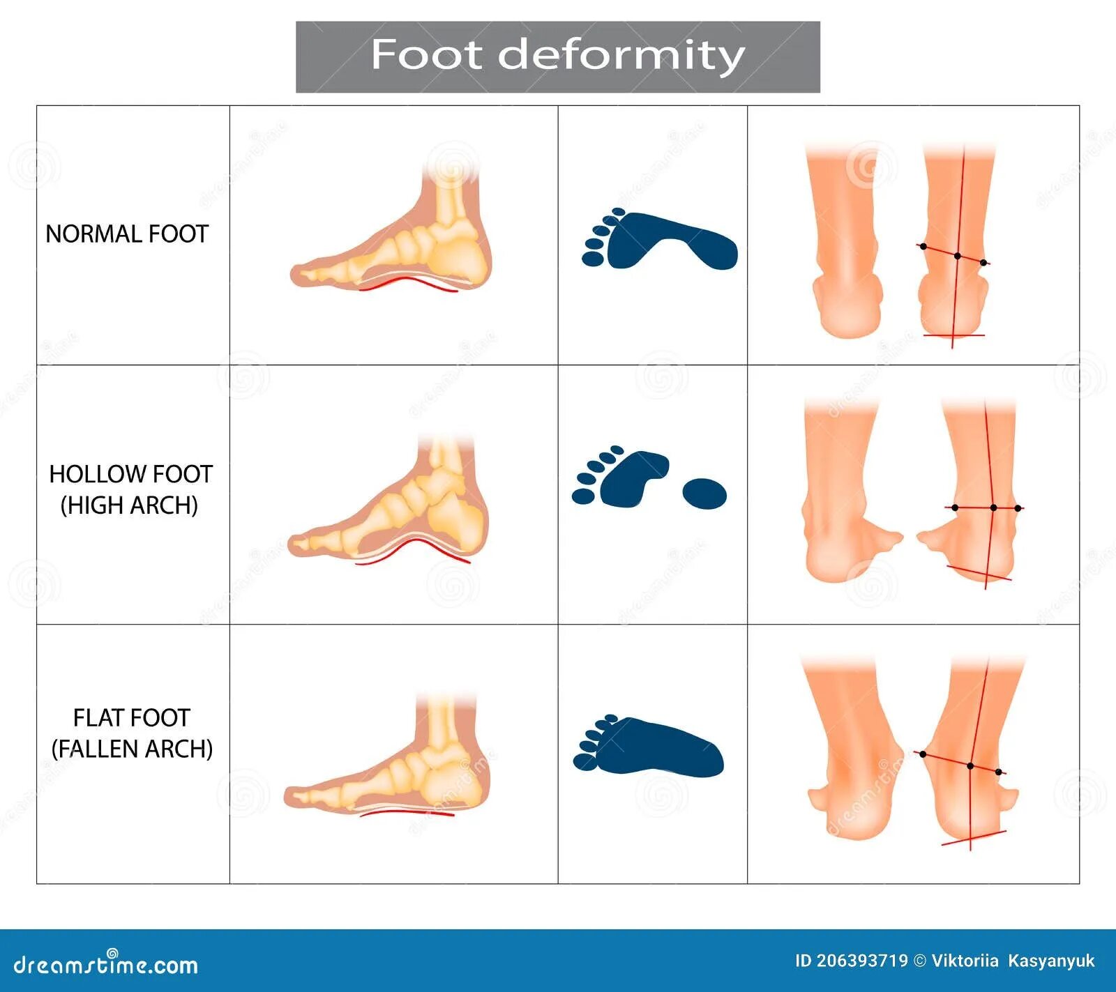 Normal feet