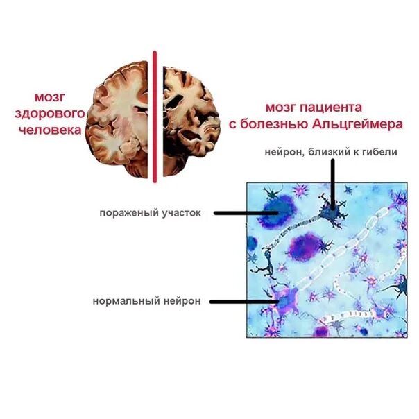 Болезнь айцгельмера это что. Сенильные бляшки при болезни Альцгеймера. Мозг при болезни Альцгеймера. Болезнь Альцгеймера гистология. Нейродегенеративные болезни.