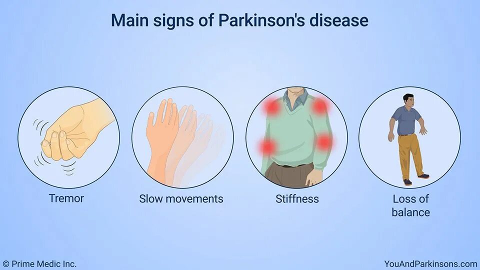 Болезнь Паркинсона. Тремор Паркинсона. Болезнь Паркинсона и Хорея.