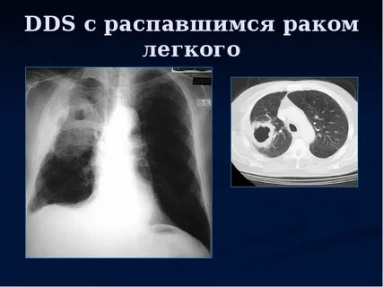 Распад опухоли е 88.3