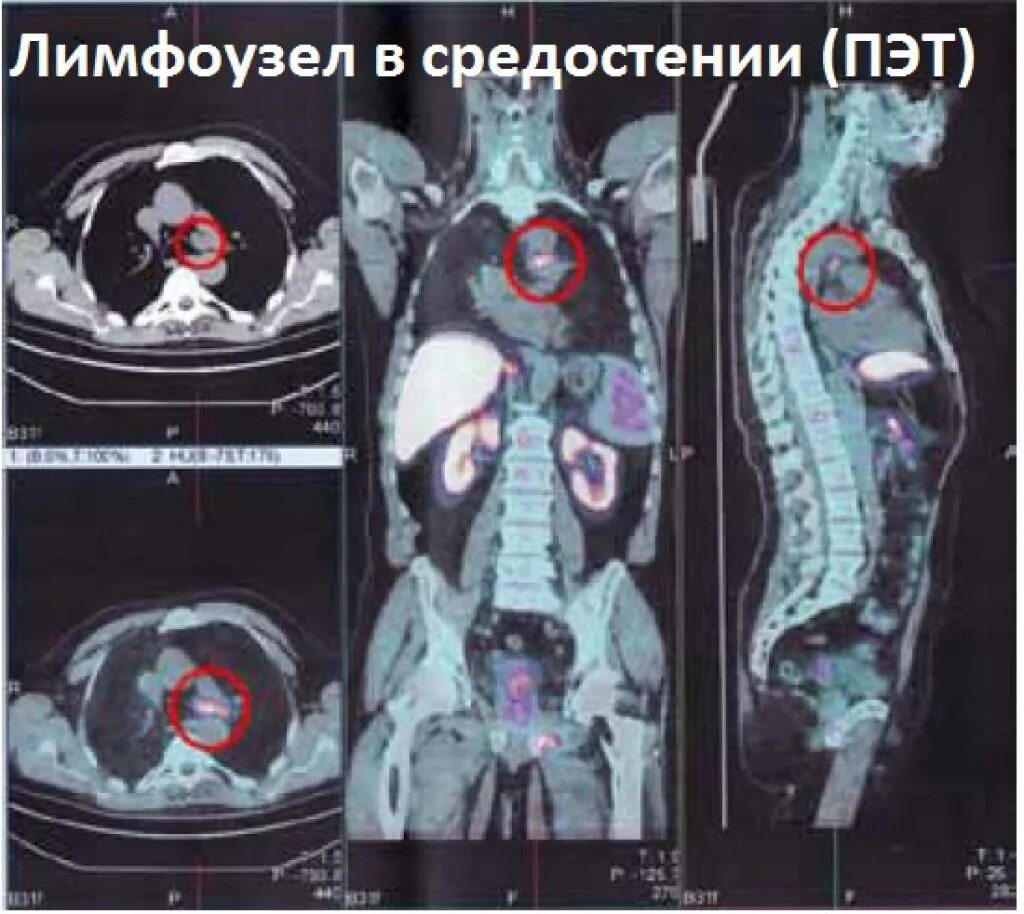 ПЭТ кт метастазы в брюшной полости. Мрт опухоли средостения. ПЭТ кт метастазы в легких. Метастазы в легких лимфоузлы