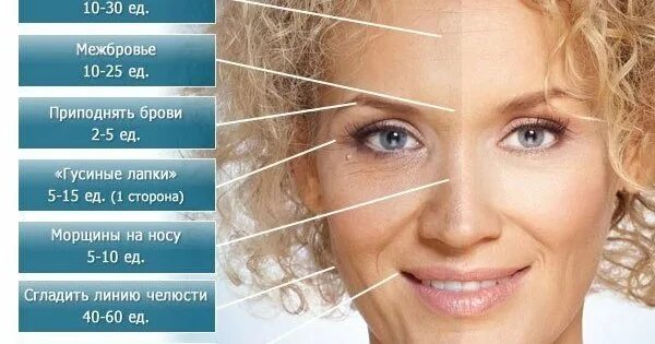 Сколько ботокса нужно в лоб. Точки диспорта для поднятия бровей. количество единиц ботокса. ботокс в лоб для поднятия брови.