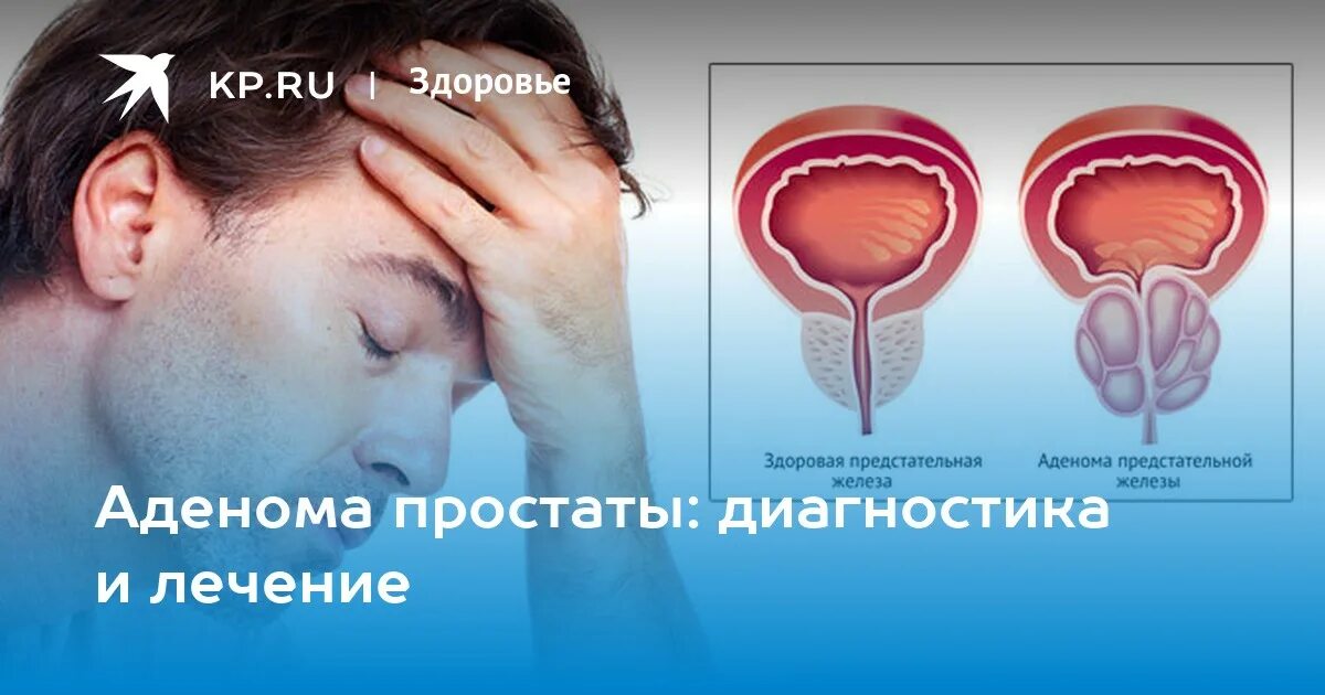 Ли аденома. Аденома простаты диагностика. как выглядит аденома простаты у мужчин фото. болезни у мужчин урология. аденома простаты виды диагностики.
