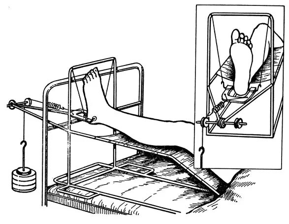 Скелетное вытяжение при переломе бедренной кости. Скелетное вытяжение на шине белера. Перелом голени вытяжение. Перелом голени вытяжение. Метод скелетного вытяжения при переломе.