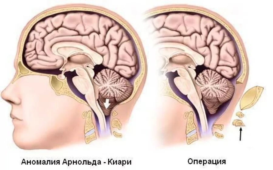 Мальформация Арнольда-Киари 2 типа. Аномалии головного мозга Арнольда Киари. Аномалия Арнольда Киари на кт.