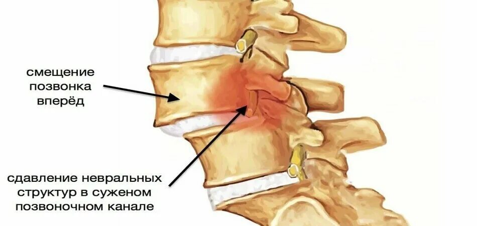 Смещение l5 позвонка кпереди. Антелистез l4 позвонка 4 мм. Ретролистез l2 l3 позвонка что это такое. Смещение дисков позвоночника. L2-l3 позвоночника смещение.