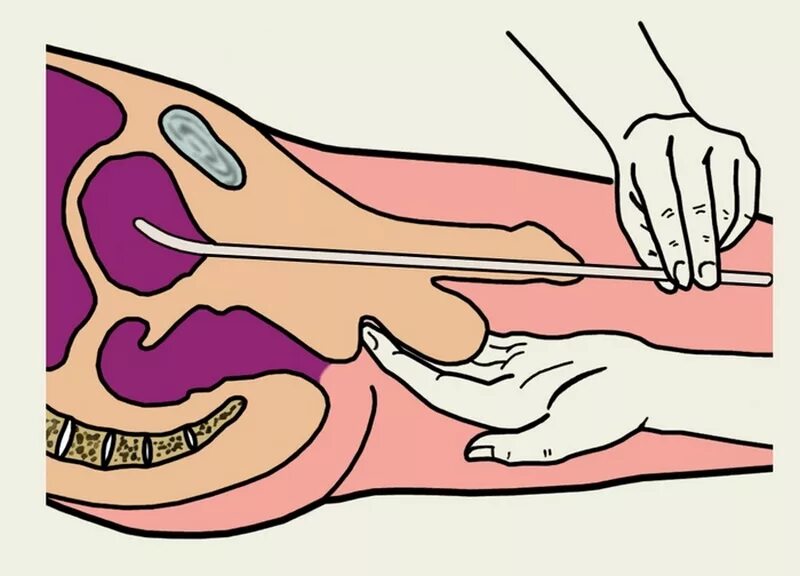 Катетер простату. Катетеризация мочевого пузыря. Катетеризация уретры и мочевого пузыря. Введение катетера в мочевой пузырь. Уретральный катетер вводится.