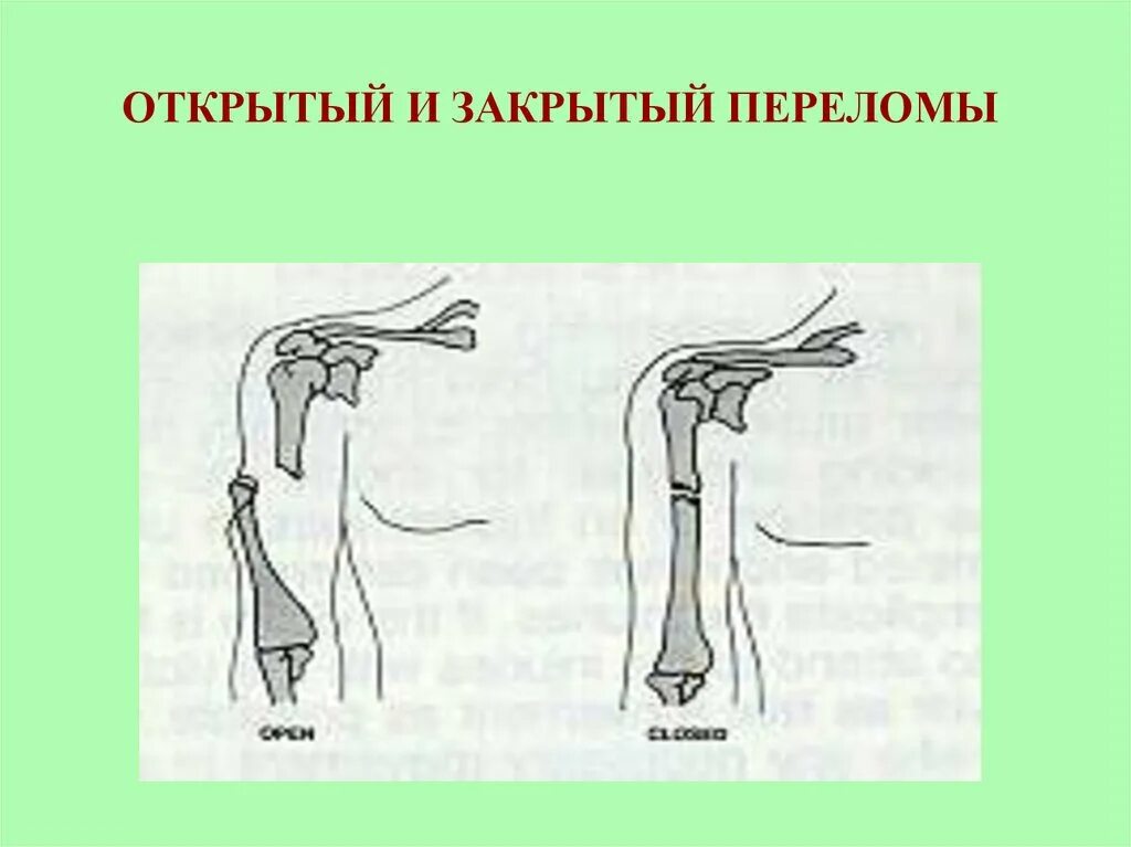 Открытый и закрытый перелом. Открытый перелом и закрытый перелом. Открытый и закрытый перелом разница. Трещина открытый и закрытый перелом.