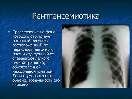 Легочные поля