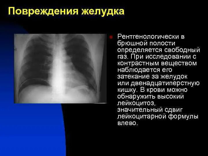 Перфорация полого органа в брюшной полости рентген. Свободный ГАЗ В брюшной полости на рентгенограмме. Свободный ГАЗ В брюшной полости рентген. Свободный ГАЗ В брюшной полости определяется при.